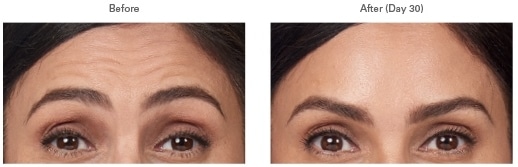Botox before and after dermal filler and injection treatment
