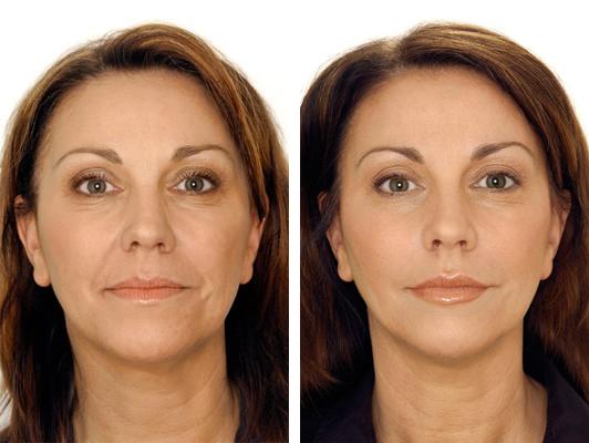 Before and after dysport wrinkle remover injectable treatment