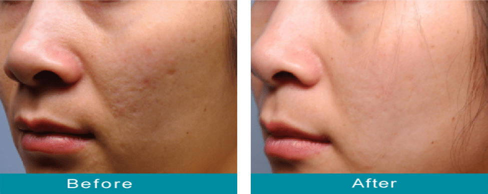 dermaplaning-before-after