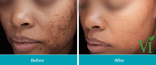 vi-peels-treatment-before-and-after-1
