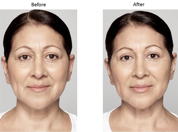 Injectables Phoenix | Cosmetic Injections | Dermal Fillers | Wrinkle Reducer