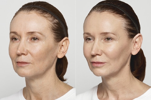 Before and after restylane lift filler injectable treatment