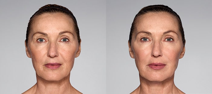 Before and after restylane refyne injectable filler treatment