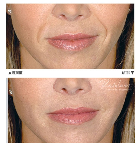 Before and after laugh line filler treatment using Restylane